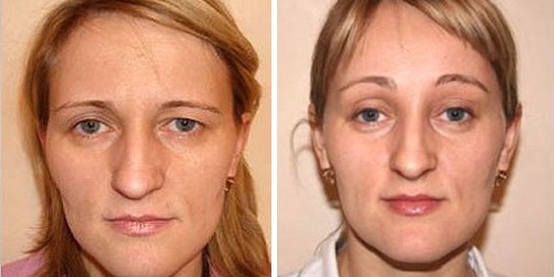 Результат эндоскопического лифтинга